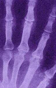 Arthritis-R�ntgen